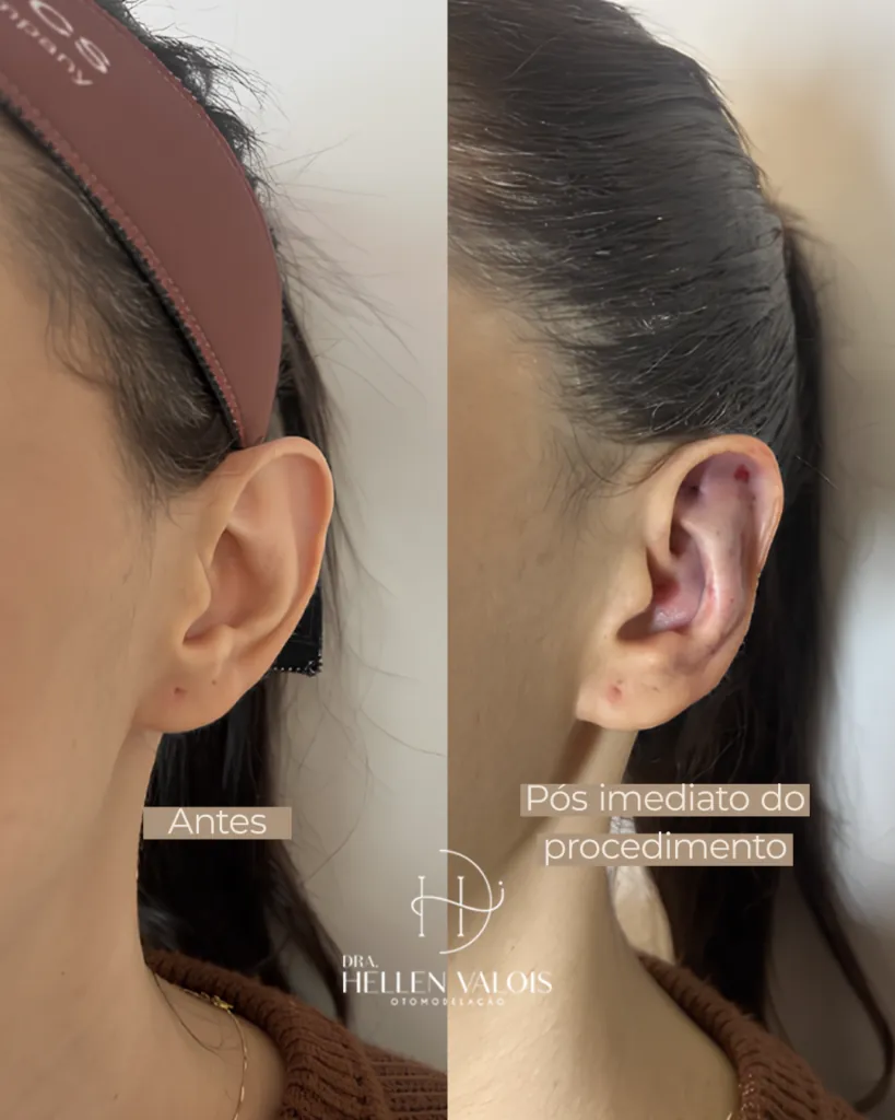 Antes e depois